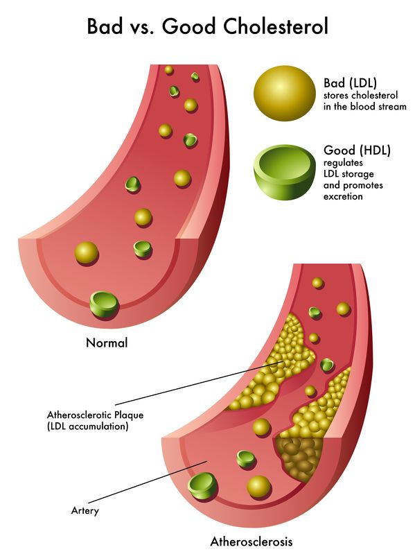 HDL vs LDL keto