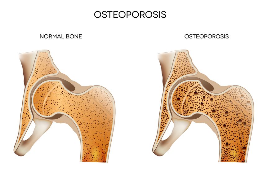 osteoporosis as a result of collagen loss