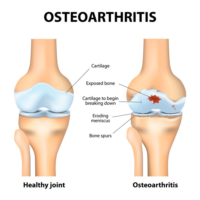 Collagen helps joints and Osteoarthritis. 