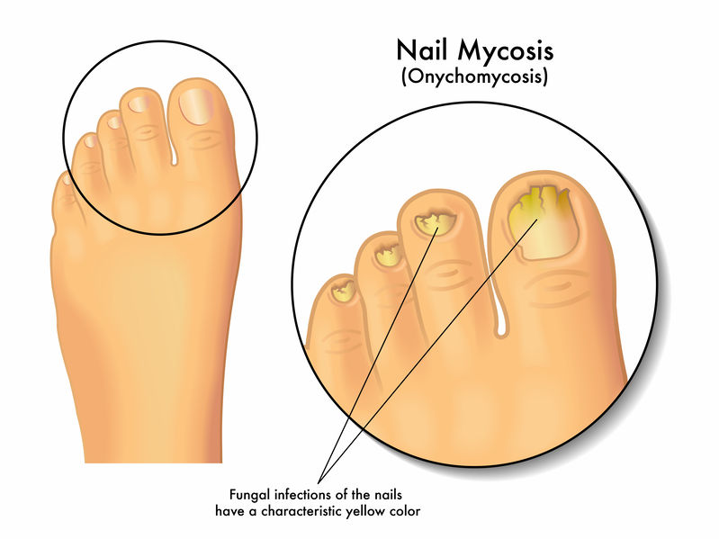 Illustration of a healthy foot together with an enlarged image of the toes with nail mycosis. The fungal infection has caused brittle, cracking, yellowing toenails.