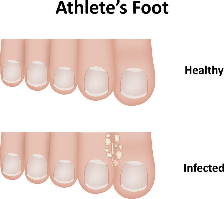 Two graphic images of a set of toes, one with healthy skin and one with infected skin showing athlete's foot. 