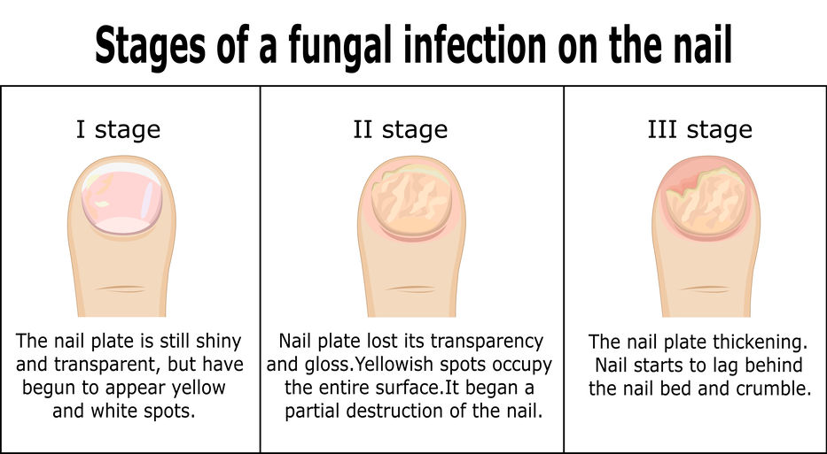 Three progressively worse stages of a fungal infection on a nail. Descriptions written underneath each vector diagram.