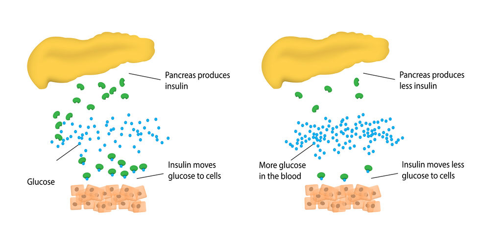 Keto diet regulates blood sugar and insulin levels.