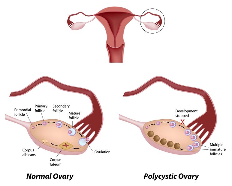 Apple cider vinegar is shown to help with polycystic ovarian syndrome. 