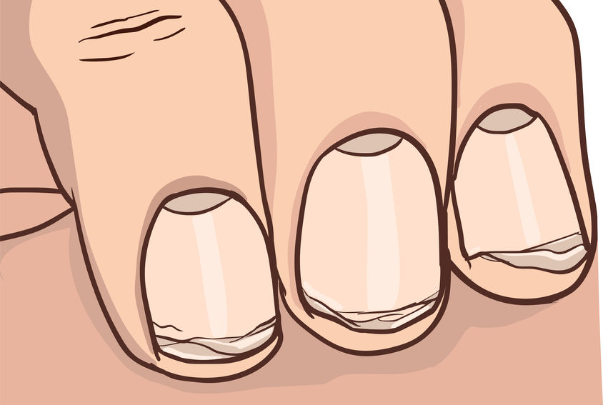 Brittle nails are a sign of protein deficiency.