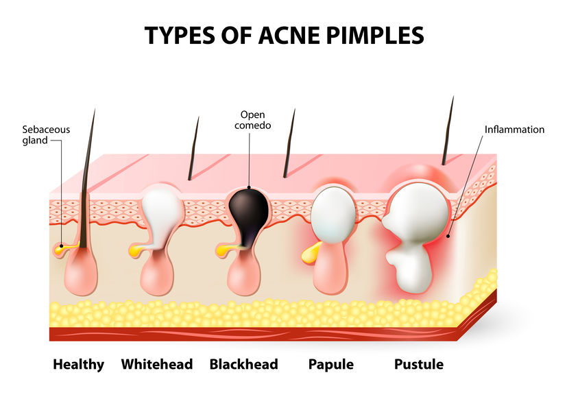 Types of acne pimples. Healthy skin, Whiteheads and Blackheads, Papules and Pustules