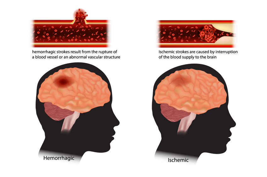 diagram of the two types of stroke. strokes classified: ischemic and hemorrhagic