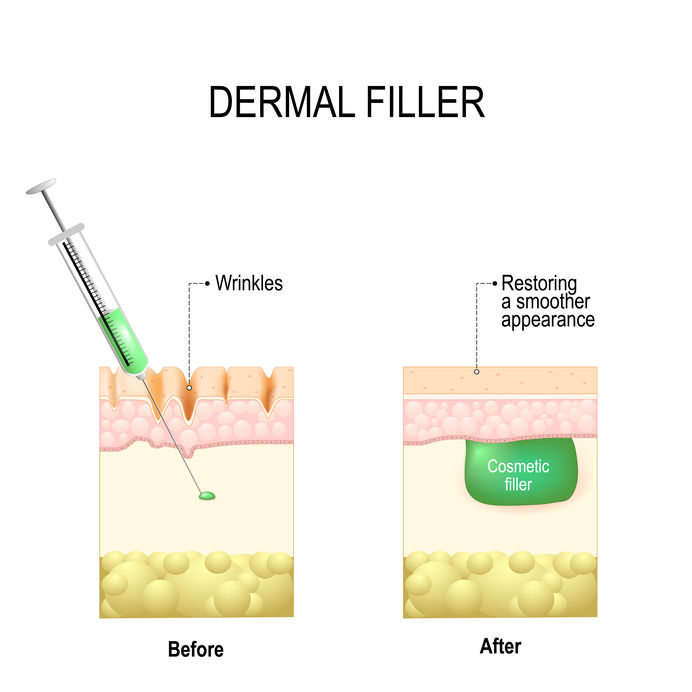 Dermal fillers come with risks.