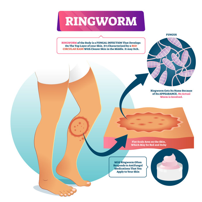 Ringworm educational picture showing ringworm illustration and closeups of appearance, causes and symptoms.
