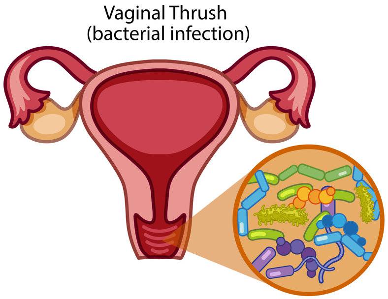 Vector image of a vaginal yeast infection including a close up of the bacteria.