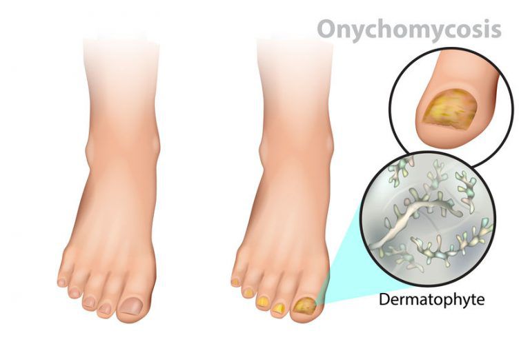 Toenails with onychomycosis, aka nail fungus, should be treated with Fungix™.