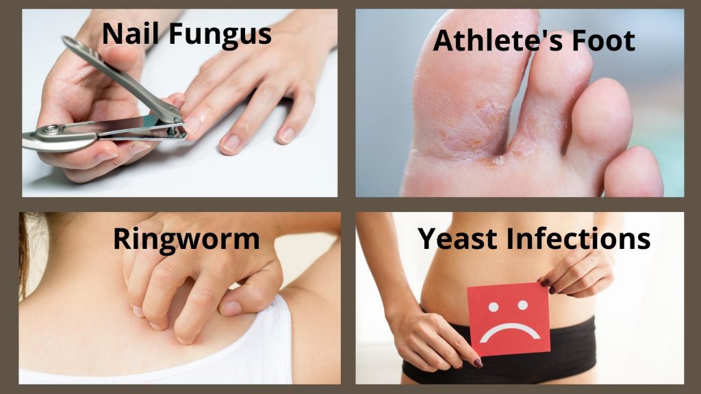 Four common fungal infections that undecylenic acid fights against. Trimming a nail, infected toes, itching ringworm and a sad face to indicate candidiasis.  