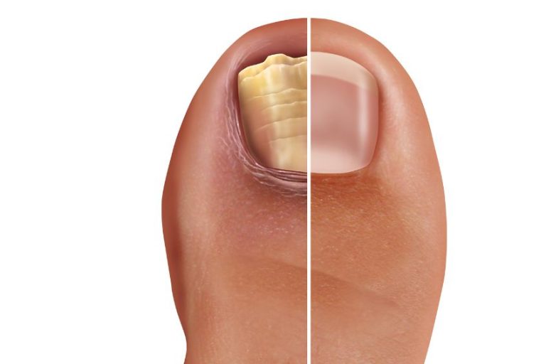 should-you-get-a-pedicure-with-toenail-fungus-approved-science-blog